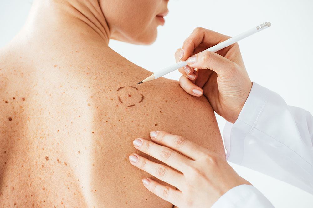 Common Types and Symptoms of Melanoma