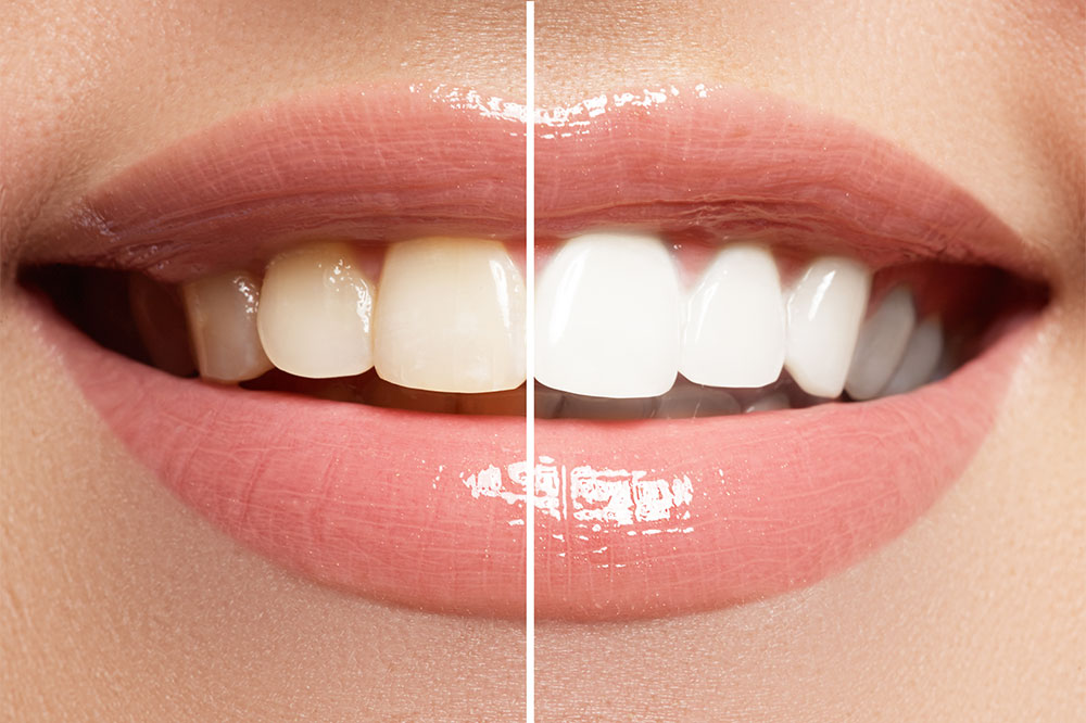 5 Effective Ways to Whiten Teeth