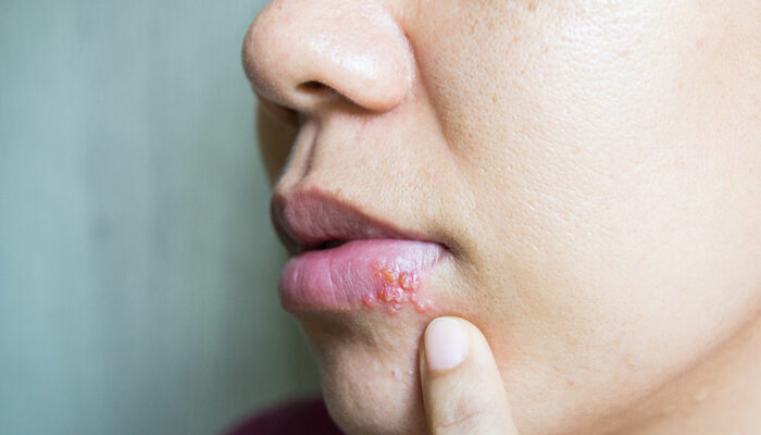 6 Causes and Triggers of Cold Sores