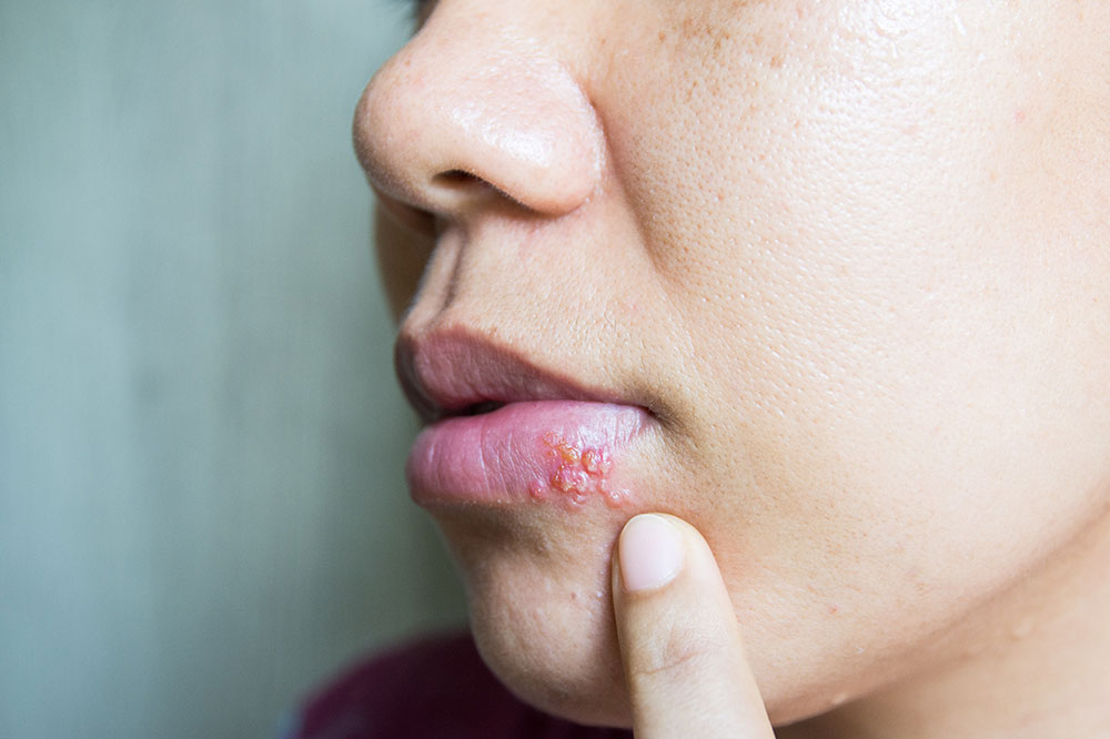 6 Causes and Triggers of Cold Sores