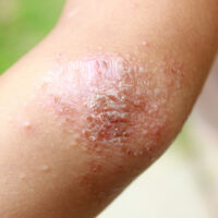 6 Unfavorable Cities for Eczema Patients