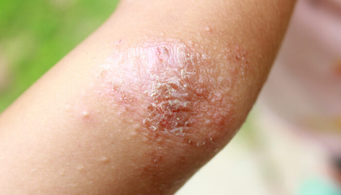 6 Unfavorable Cities for Eczema Patients