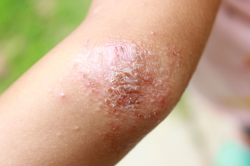 6 Unfavorable Cities for Eczema Patients